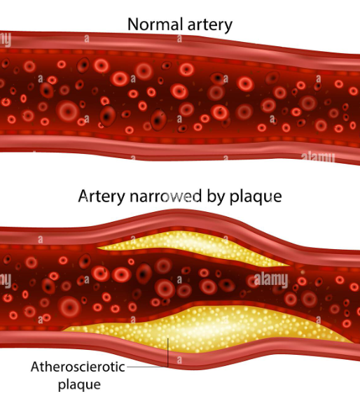 <p>Normal artery</p><p>Artery with plaque build-up</p>