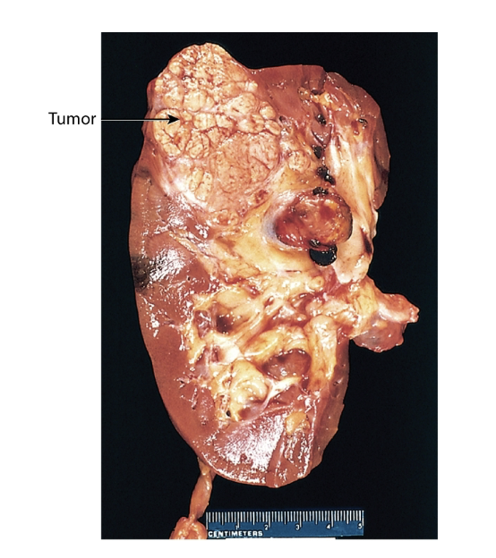 <p>renal cell carcinoma</p>