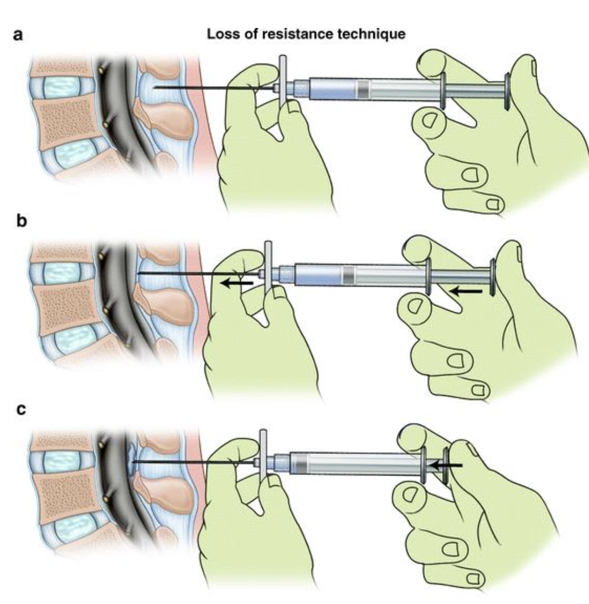 <p>Sudden "loss of resistance" to pressure on the syringe plunger</p>
