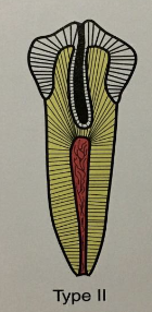 <p>“dens in dente” type II</p>