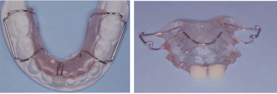 <p>In cooperative patients</p><p>In patients with poor oral hygiene</p><p>When the replacement is far away</p><p><strong>Always bilateral for retention reasons </strong></p>