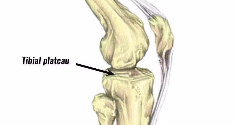 <p>Resected flat to seat the tibial baseplate.</p>