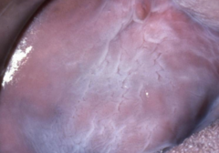 <p>Common benign white/gray mucosal change.</p>