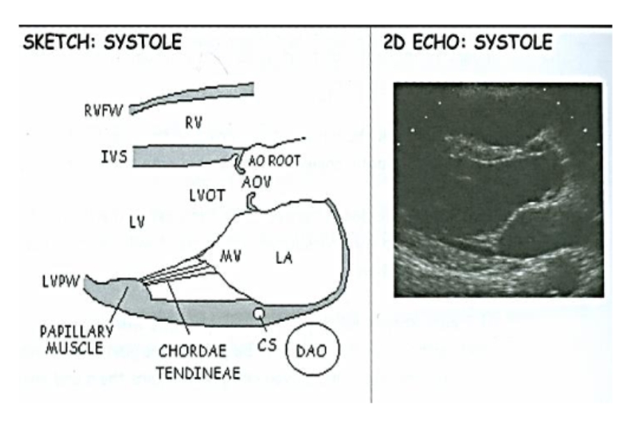 <p>Coronary Sinus Diagram/ Dilated CS </p>