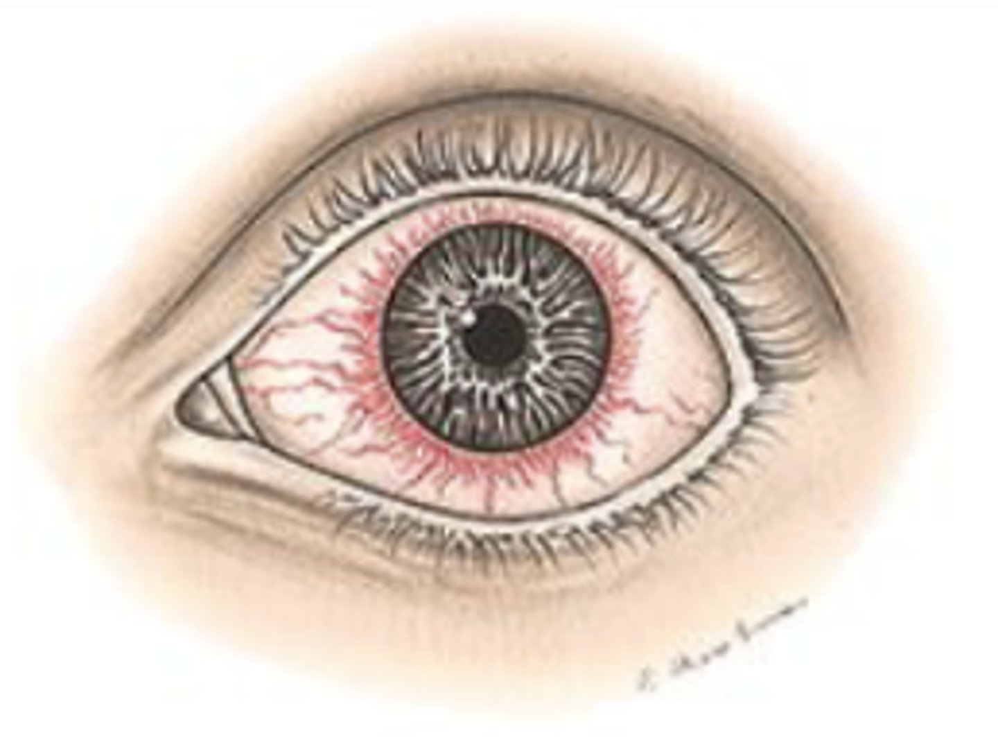 <p>Deeper vessels radiating from the limbus are dilated, creating a reddish-violet flush. The eye may also be diffusely red.</p><p>Moderate to severe, superficial</p><p>Vision Usually decreased</p><p>Watery or purulent discharge</p><p>Significance: Abrasions, and other injuries; viral and bacterial infections</p>