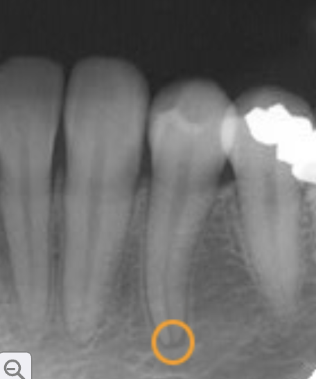 <p>apical foramen</p>