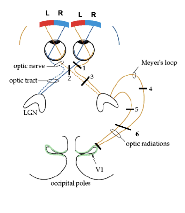 <p>tunnel vision (can see medial half) </p>
