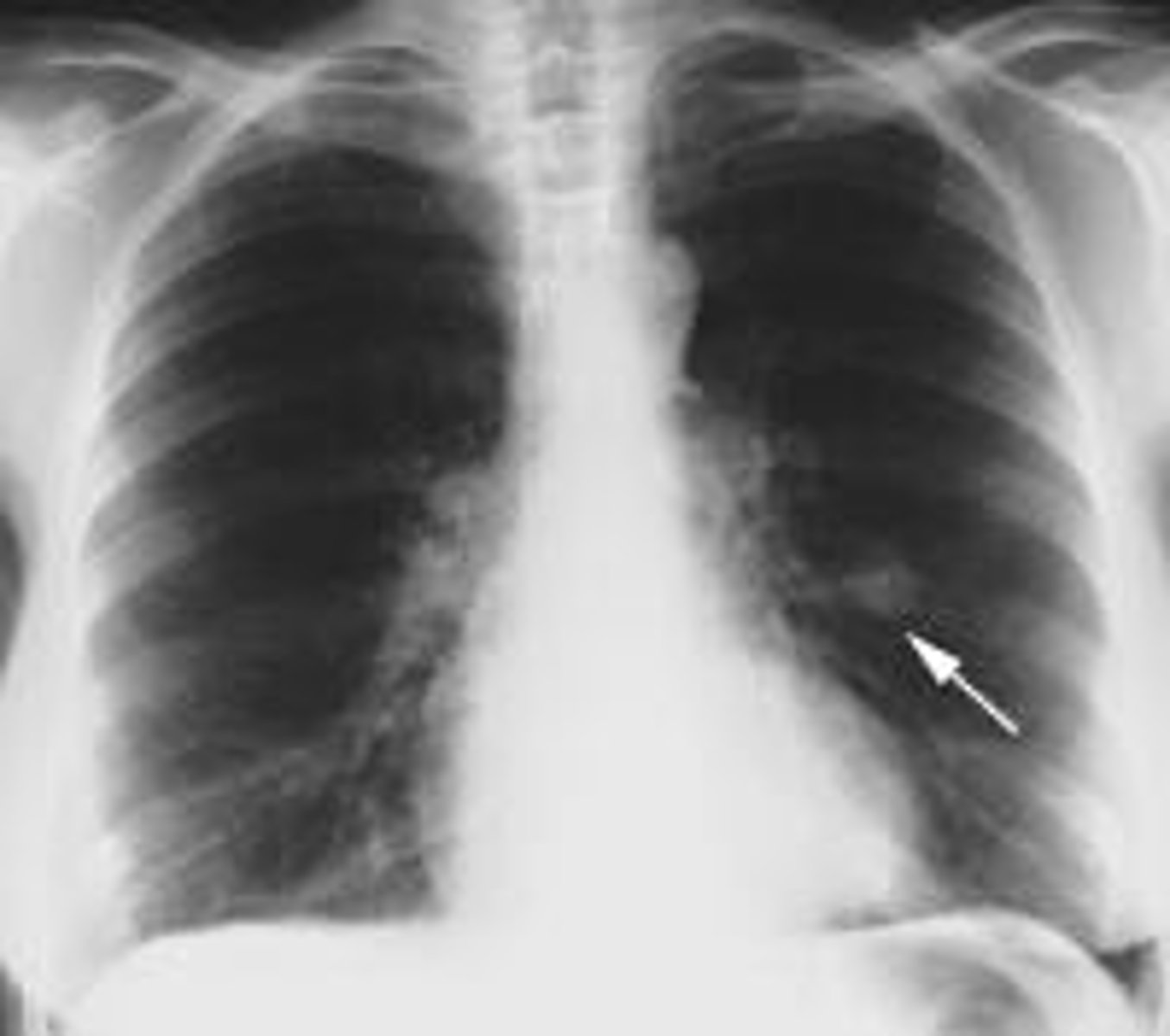 <p>benign peripheral pulmonary mass</p>