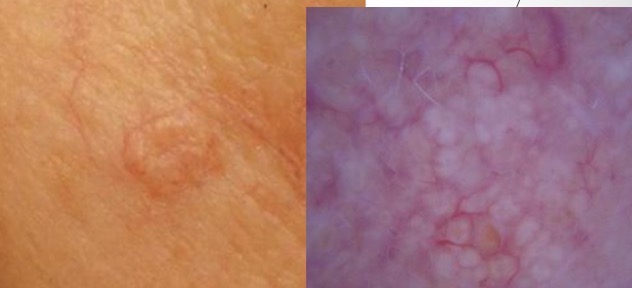 <p>Nodular Basal Cell Carcinoma</p><ul><li><p>pink papule w/ translucent or pearly white appearance (maybe focal pig)</p></li><li><p>usually w/ overlying telangiectasias</p></li></ul><p>MIMIC: Sebaceous Hyperplasia</p><ul><li><p>yelllowish globular papules, usually w/ central depression</p></li><li><p>telangeictasis go AROUND</p></li></ul><p></p>