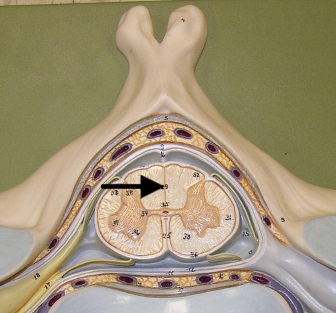 <p>Posterior median sulcus</p>