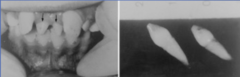 <p>small peg-shaped conical tooth that presents as a mesiodens between maxillary central incisors that rarely erupts labially</p>