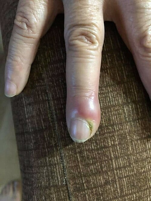 <p>Infection of the nail fold, usually due to S. aureus </p><p>-Presentation: sudden pain, redness, swelling, and pus in a patient who bites their nails, sucks their fingers, has hangnails, or got a manicure </p><p>-Dx: clinical, culture pus</p><p>-Tx: warm soaks + topical mupirocin if without abscess, I&amp;D if with abscess </p>