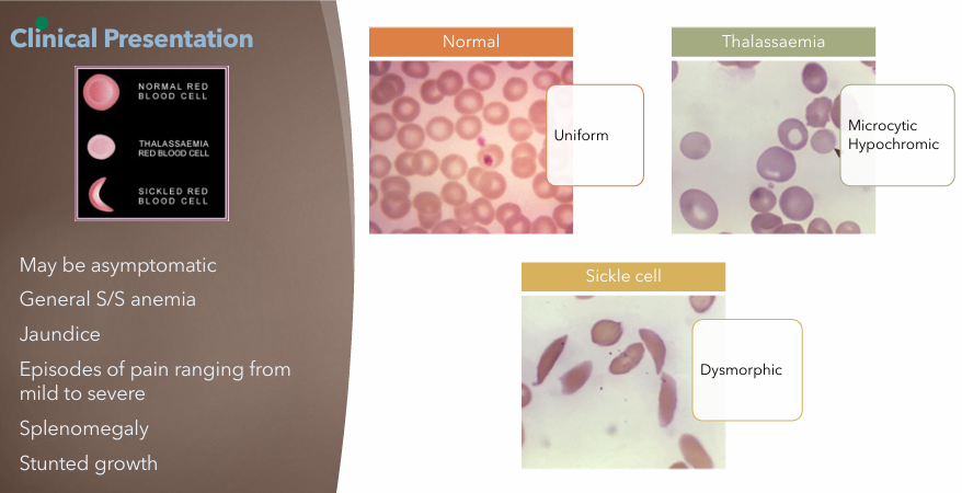 <ul><li><p>May be asymptomatic</p></li><li><p>General S/S anemia</p></li><li><p>Jaundice</p></li><li><p>Pain episodes (mild to severe)</p></li><li><p>Splenomegaly</p></li><li><p>Stunted growth</p></li></ul><p></p>