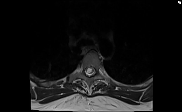 <p><strong>Syringomyelia (syrinx)</strong> i</p>