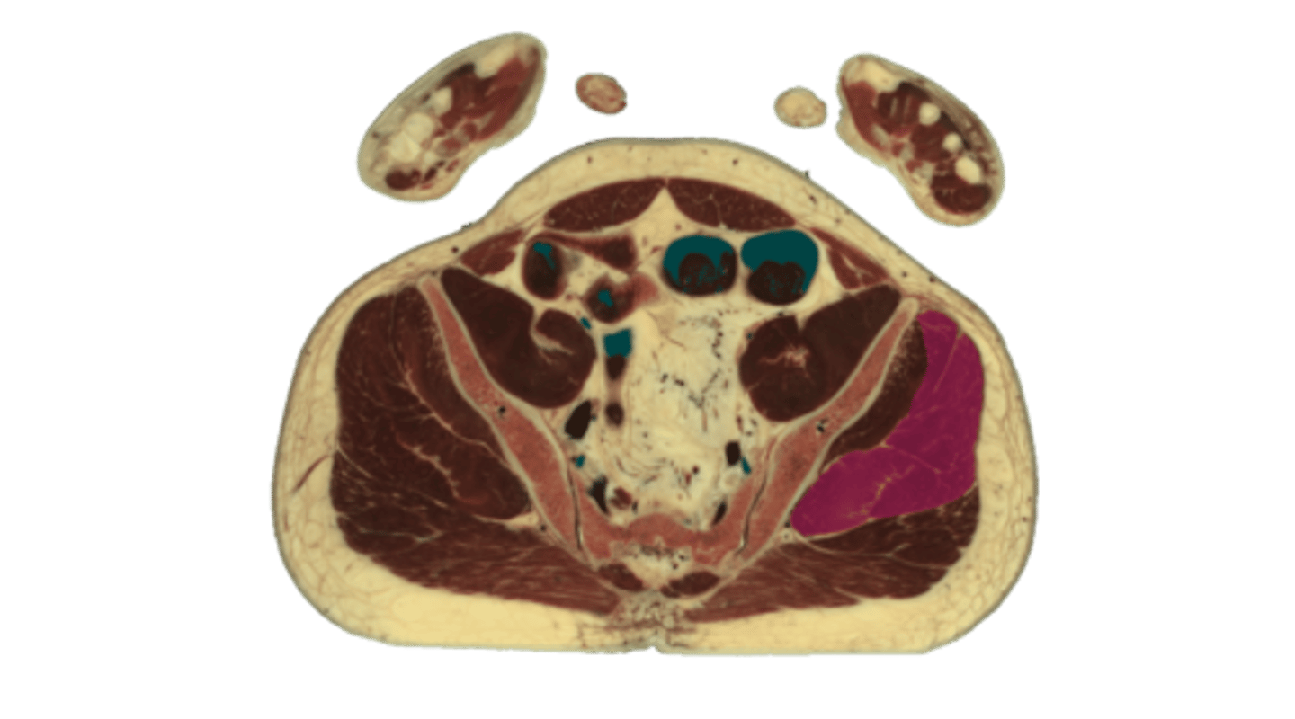 <p>Which muscle is highlighted in pink on this transverse cross section of the pelvis?</p><p>A) gluteus minimus</p><p>B) gluteus medius</p><p>C) gluteus maximus</p><p>D) piriformis</p><p>E) tensor fascia lata</p>