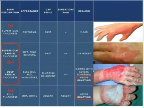 <p>Burns Classification and Graft Methods</p>