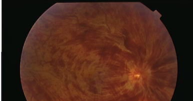 <p>Name the condition</p>