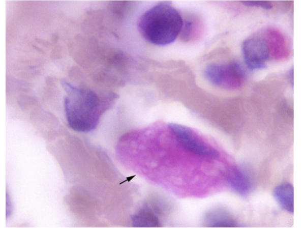 <p>What stain is used for viewing <strong>Gaucher cells in Gaucher’s Disease? </strong></p>