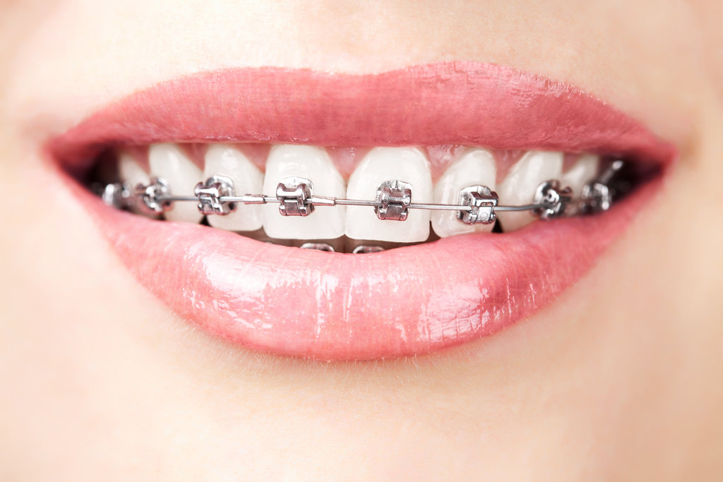 <p>Temporary</p><p>My braces are temporary.</p>