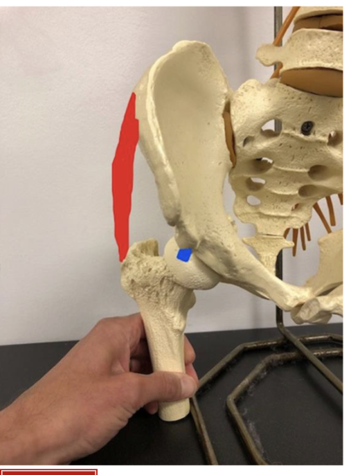 <p><strong>Femoral Head Coverage (Area)=</strong></p><ul><li><p>reduced <strong><br></strong></p></li></ul><p><strong>MA of Glut Med (to produce ABD)=</strong></p><ul><li><p>reduced</p></li></ul><p></p><p><strong>Force Needed from Glut Med=</strong></p><ul><li><p>increased</p></li></ul><p></p><p><strong>Joint Stress=</strong></p><ul><li><p>increased → FHC (Area) reduced and Force increased</p><ul><li><p>S = F/A</p></li></ul></li></ul><p></p>