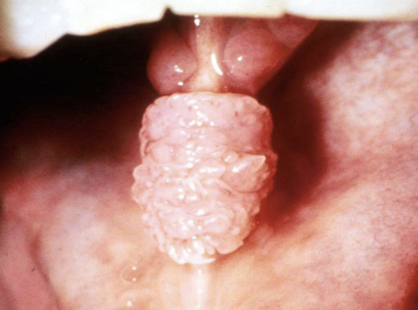 <p>Base of Lesion : stalk like </p>