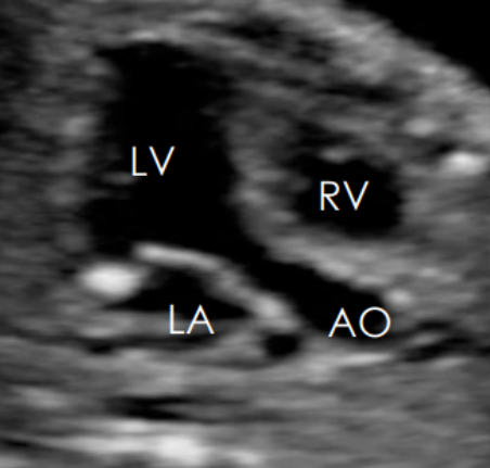 <ul><li><p><span style="background-color: transparent;">Aortic and LV connection</span></p></li><li><p><span style="background-color: transparent;">LA</span></p></li><li><p><span style="background-color: transparent;">Aortic root</span></p></li><li><p><span style="background-color: transparent;">Aortic valve (AV) </span></p></li><li><p><span style="background-color: transparent;">Ventricular septum</span></p></li></ul><p></p>