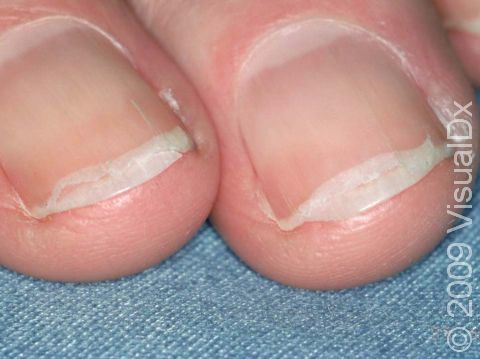 <p>what nail condition is this?</p>