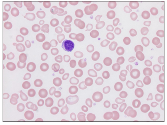 <p>- Partially treated iron deficiency</p><p>- both small pale and cells (residual iron deficient cells) and normal RBC</p>