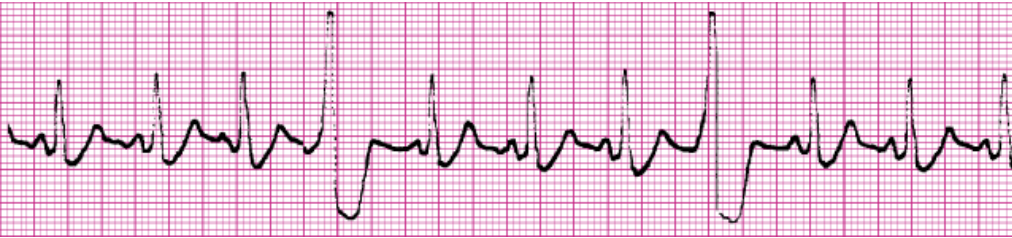 <ul><li><p><span style="background-color: transparent;">Single irritable focus within the ventricles that fires prematurely to initiate an ectopic beat</span></p></li><li><p><span style="background-color: transparent;">Regular rhythm with one early beat</span></p></li><li><p><span style="background-color: transparent;">P waves present except for the early beat</span></p></li><li><p><span style="background-color: transparent;">Normal QRS except an early beat will be >0.12 seconds</span></p></li><li><p><span style="background-color: transparent;">Consider lidocaine or procainamide</span></p></li><li><p><span style="background-color: transparent;">R on T phenomenon</span></p><ul><li><p><span style="background-color: transparent;">PVC lands directly on the T wave during the hearts vulnerable phase</span></p></li></ul></li><li><p><span style="background-color: transparent;">Tx is amiodarone or lidocaine bolus then drip</span></p></li></ul><p></p>