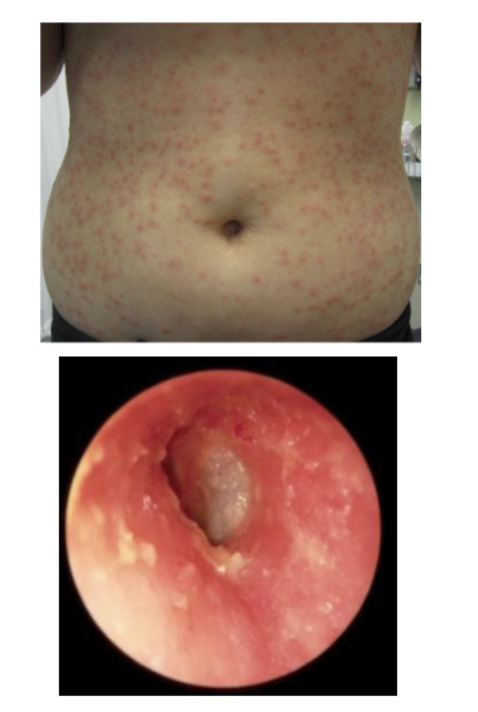 <p><strong>Contact with contaminated water</strong> through activities like swimming in pools or using hot tubs</p><ul><li><p>Hot tub folliculitis</p></li><li><p>Swimmers ear</p></li></ul><p></p>