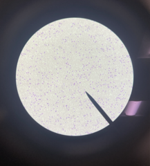 <p>A type of cancer characterized by the bone marrow creating too many lymphocytes</p>