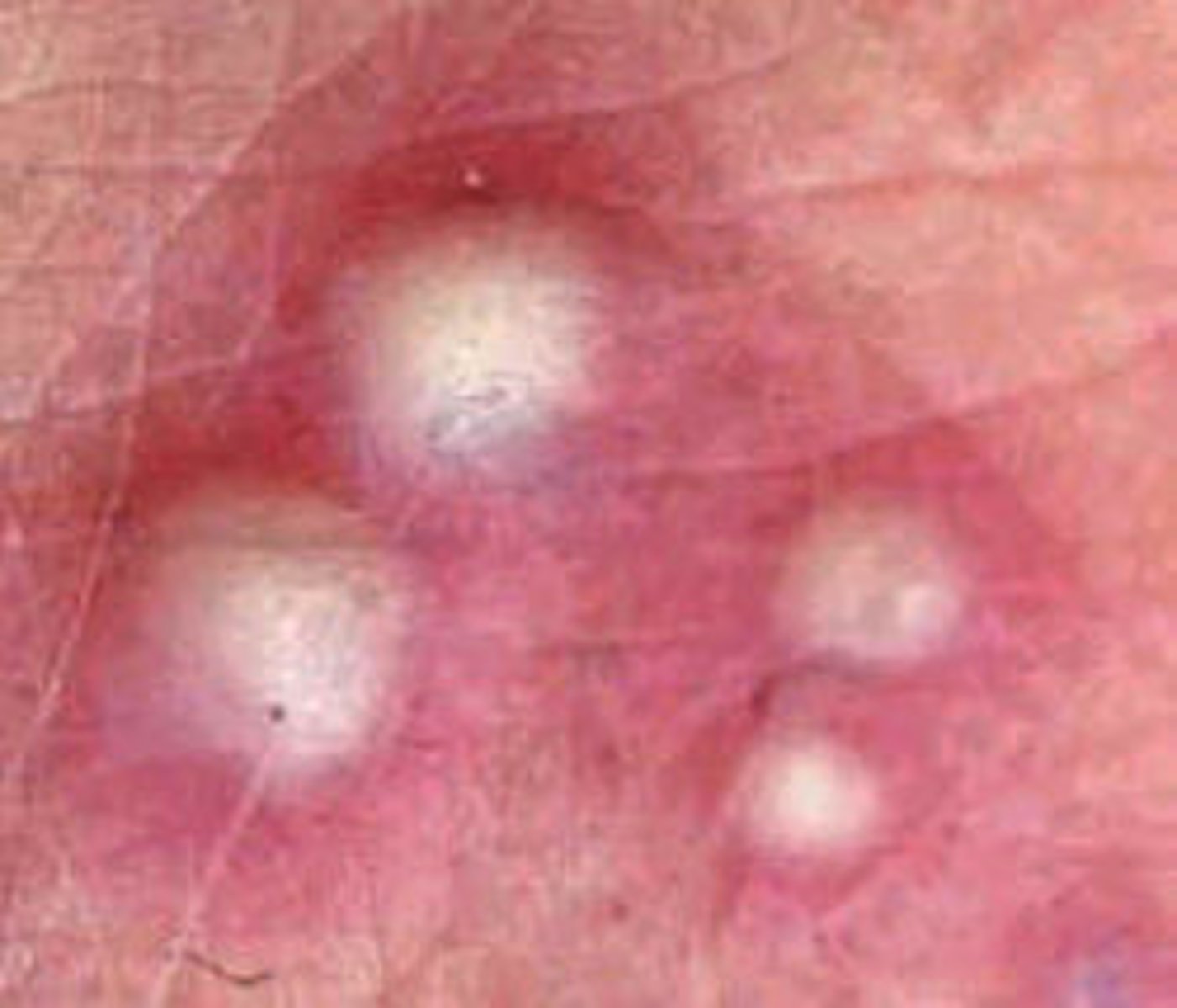 <p>Raised, inflamed papule with a white or yellow center containing pus in the top of the lesion referred to as the "head" of the pimple.</p>