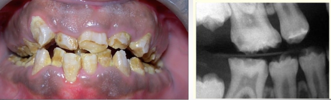 <p>Amelogenesis imperfecta </p>