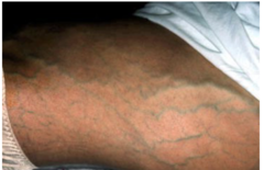 <p>dilated veins</p>