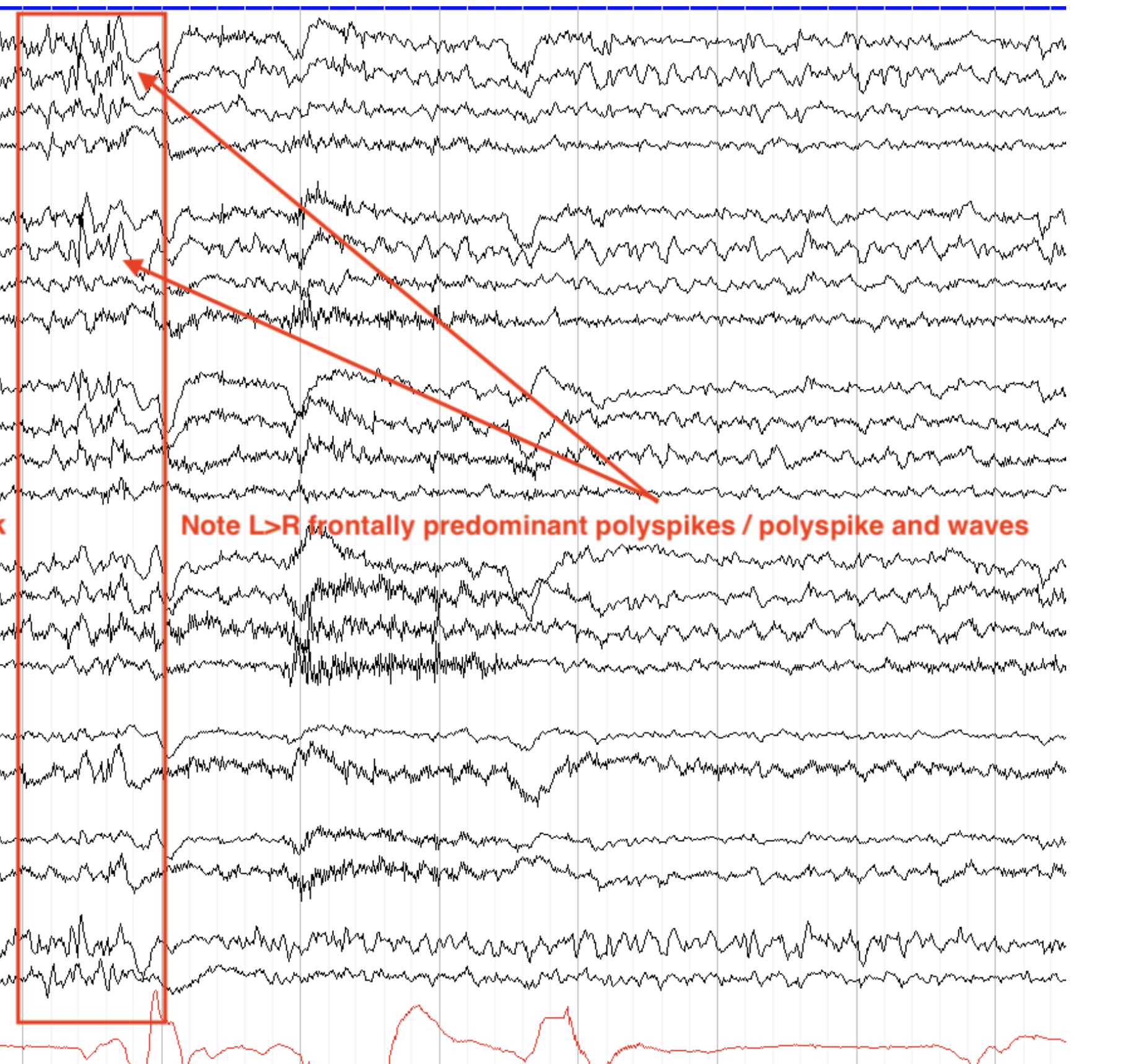<p>polyspikes/brief</p>