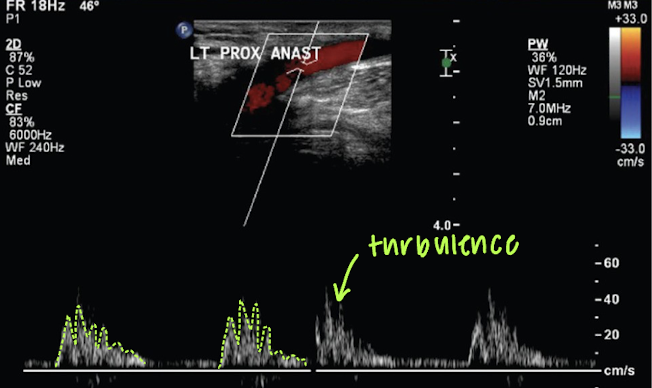 <p>turbulence (velocity changes)</p>