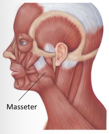 <p>Masseter insertion</p>