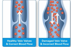 <p> Low pressure flow</p><p> Rich sympathetic innervation – so in sympathetic vasoconstriction – blood from veins supply a large portion of venous return</p><p> Carry blood back to heart</p><p></p><p><span style="color: purple;">tunica media less developed</span> - so <span style="color: purple;">less collagen, elastin and smooth muscle cells</span></p><p>histology compares flattened vein with bigger lumen with thinner tunica media compared to artery</p><p></p><p>Valves in veins are delicate, two-flap structures that act as <strong>one-way</strong> doors to ensure blood flows toward the heart and prevent backflow (venous reflux) caused by gravity.</p><p></p><p>Primarily found in the <span style="color: purple;">limbs</span>, these <strong>valves </strong>open as blood travels upward and close when blood halts, ensuring, for example, that blood in the legs does not</p>