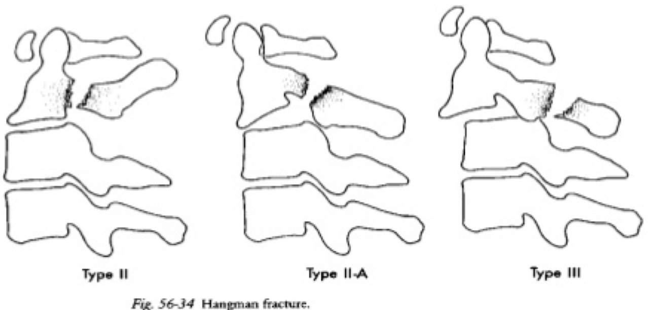 <p>Type 1</p><ul><li><p><3mm displacement with no angulation of anterior aspect of fracture</p></li></ul><p>Type 2</p><ul><li><p>Greater forward angulation than type 1</p></li><li><p>Cervical traction with halo vest required</p></li></ul><p>Type 3</p><ul><li><p>Severe angulation and/or facet dislocation</p></li><li><p>Requires surgical restoration</p></li></ul><p></p>