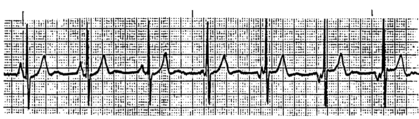 <p>What ECG is this? </p>