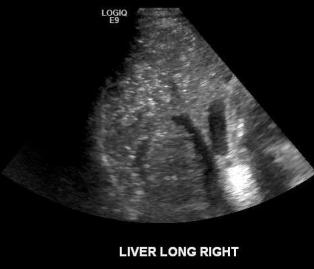<p>Pneumobili: Tends to lay centrally</p><p>Portal venous gas: tends to involve peripheral segments. Color doppler will reveal numerous spikes.</p>