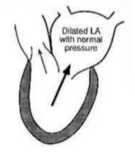 <ul><li><p>LV volume load (increased preload) → LV eccentric hypertrophy, LV dilation</p></li><li><p>until LA pressure normal + CO normal= asymptomatic</p></li><li><p>decreased LV compliance→ increased LVEDP, LAP- backward failure</p></li><li><p>decreased LV contractility → decreased CO, forward failure</p><ul><li><p>these 2 ⇒ symptoms</p></li></ul></li><li><p>untreated cases= pulmonary pressure increase → RV failure</p></li></ul><p></p>