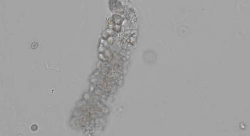 <p>Seen with glomerular damage</p><p>MUST have free floating RBCs to call</p><p>Group of RBCs with matrix around them</p>