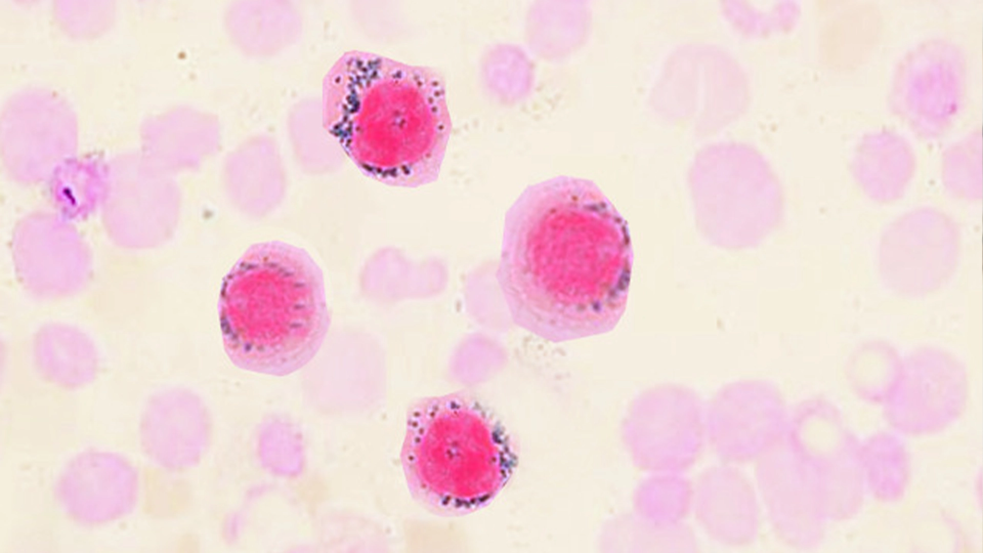 <p>what would the PB look like in sideroblastic anemia? <strong>(learning objective)</strong></p>