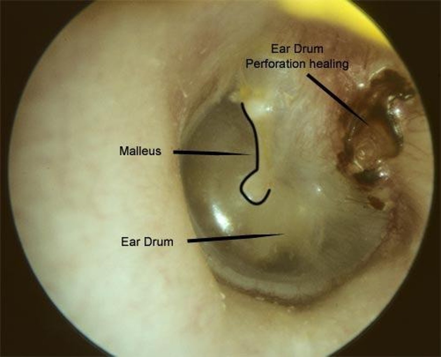 <p>Rupture of eardrum, leading to hearing loss.</p>