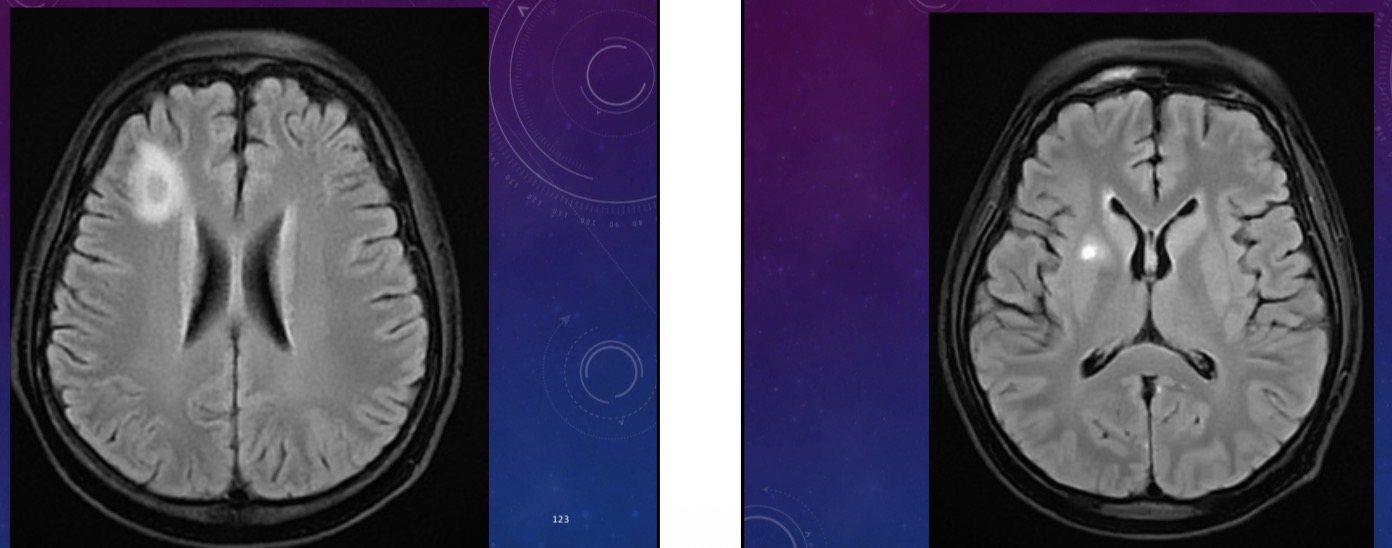 <p>30-year-old female presents with fever and AMS for five days with underlying immunosuppressive illness and stem cell transplant. Scan shows multiple ring enhancing lesions</p>