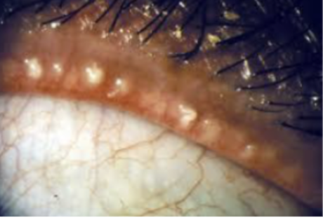 <p><span style="background-color: transparent;"><strong><u>Posterior</u> Blepharitis</strong>:</span></p><ul><li><p><span style="background-color: transparent;">Swollen eyelids</span></p></li><li><p><span style="background-color: transparent;">Capping of meibomian gland orifices with oil globules</span></p></li><li><p><span style="background-color: transparent;">Dry eye symptoms in almost all patients</span></p></li><li><p><span style="background-color: transparent;">Associated conditions: Cutaneous Rosacea, Seborrhoeic dermatitis, Acne vulgaris treated with isotretinoin, Long-term contact lens wear</span></p></li><li><p><span style="background-color: transparent;"><u>Melbomian Gland Dysfunction</u></span></p><ul><li><p><span style="background-color: transparent;">Eyelash <u>misdirection</u> may occur with long-standing disease</span></p></li><li><p><span style="background-color: transparent;"><u>Excess lipid, foamy discharge</u> (eyelid deposits)</span></p></li><li><p><span style="background-color: transparent;">Eyelid <u>scarring</u> may occur with long-standing disease</span></p></li><li><p><span style="background-color: transparent;"><u>Occasional to frequent, some times multiple chalazia</u></span></p></li><li><p><span style="background-color: transparent;"><u>Mild-to-moderate</u> injection, <u>papillary</u> reaction of tarsal conjunctiva&nbsp;</span></p></li><li><p><span style="background-color: transparent;">Aqueous Tear deficiency</span></p></li><li><p><span style="background-color: transparent;"><u>Inferior and superior</u> punctate epithelial erosions, fine infiltrates superiorly and inferiorly, scarring, neovascularization and pannus, ulceration (Cornea)</span></p></li><li><p><span style="background-color: transparent;">Derm Disease: <u>Rosacea</u></span></p></li></ul></li></ul><p></p>