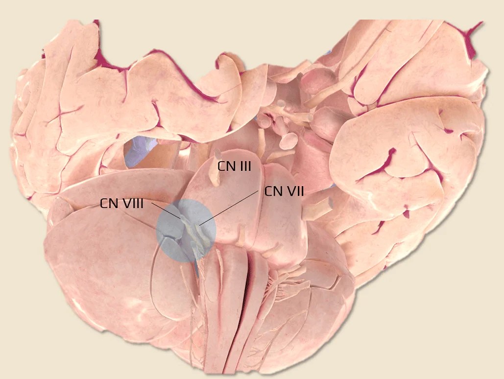 <p>-tumour between the pons and cerebellum </p><p>-affects VII and VIII, later affects V and VI </p>