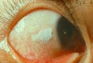 <p>Foamy plaques of the cornea that are a sign of vitamin A deficiency</p>