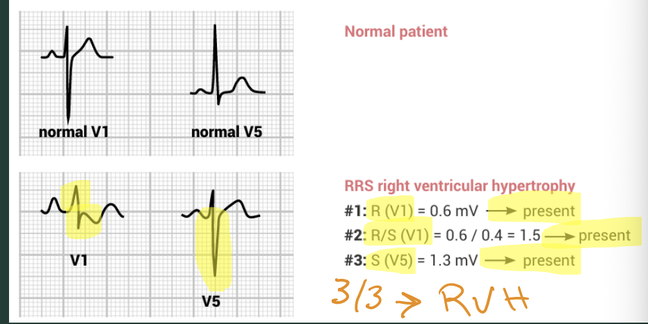 <p>V1: R>5mm, V1: R>S (R/S ratio), V5: S>5mm</p><p>2 or more criteria must be present to consider RVH</p>